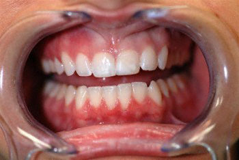 After bonding procedure